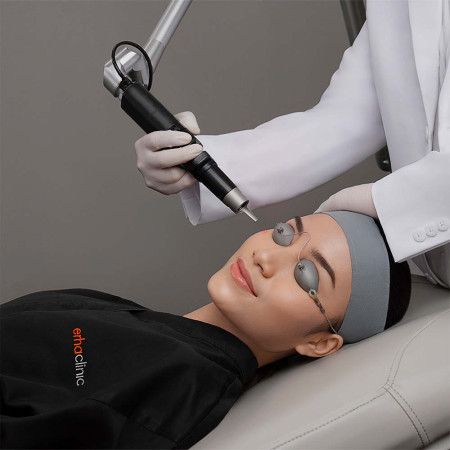 Laser Treatment